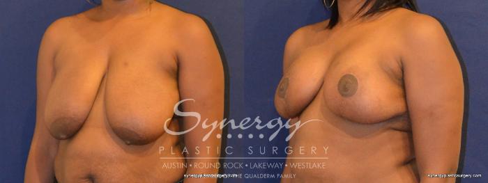 Before & After  Case 349 View #5 View in Austin, TX