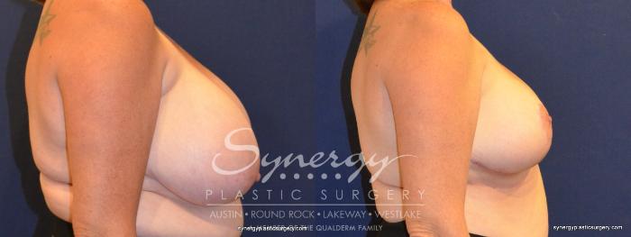 Before & After Breast Reduction Case 363 View #2 View in Austin, TX