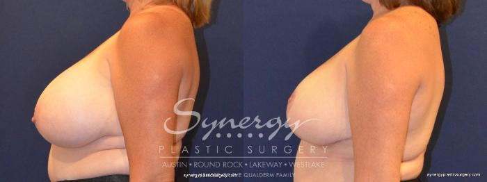 Before & After Breast Reduction Case 363 View #4 View in Austin, TX