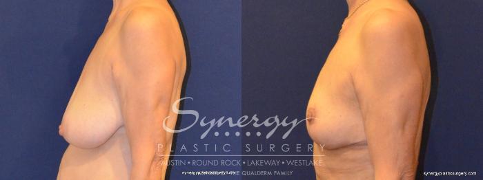 Before & After  Case 375 View #4 View in Austin, TX