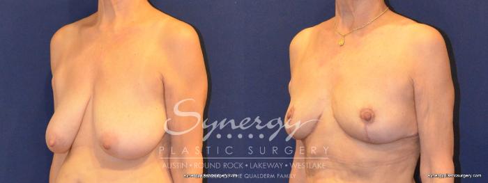 Before & After  Case 375 View #5 View in Austin, TX