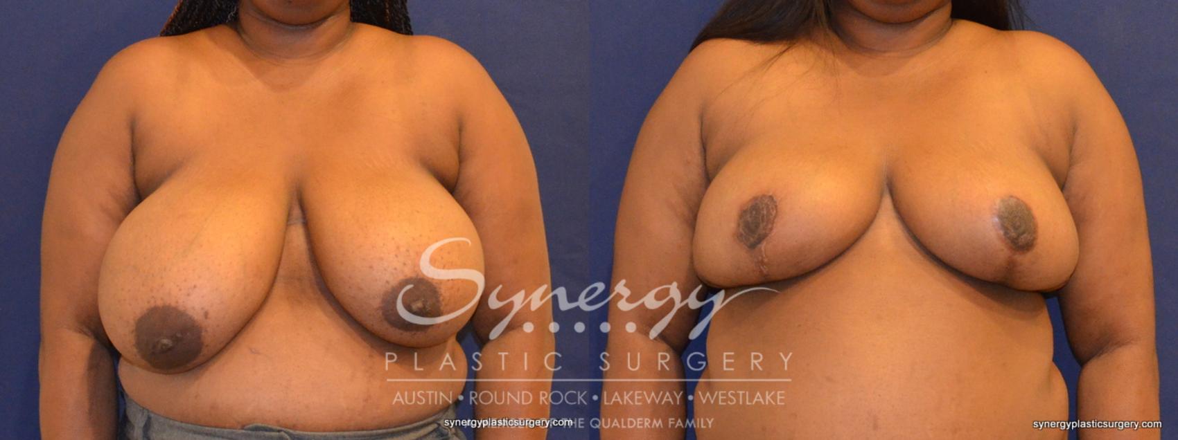 Before & After  Case 392 View #1 View in Austin, TX