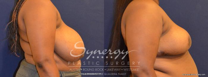 Before & After  Case 392 View #2 View in Austin, TX