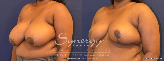 Before & After  Case 392 View #5 View in Austin, TX