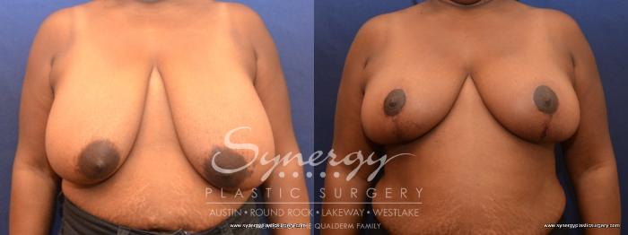 Before & After Breast Reduction Case 467 View #1 View in Austin, TX