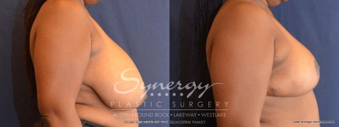 Before & After  Case 467 View #3 View in Austin, TX