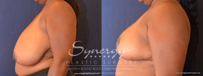 Before & After  Case 467 View #5 View in Austin, TX