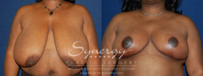 Before & After Breast Reduction Case 47 View #1 View in Austin, TX
