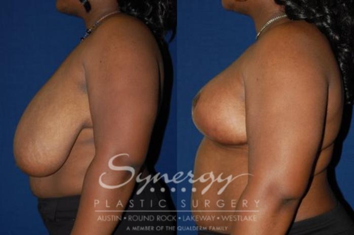 Before & After  Case 47 View #2 View in Austin, TX