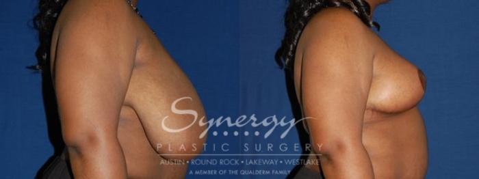 Before & After  Case 47 View #5 View in Austin, TX