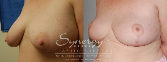 Before & After Breast Reduction Case 5 View #4 View in Austin, TX