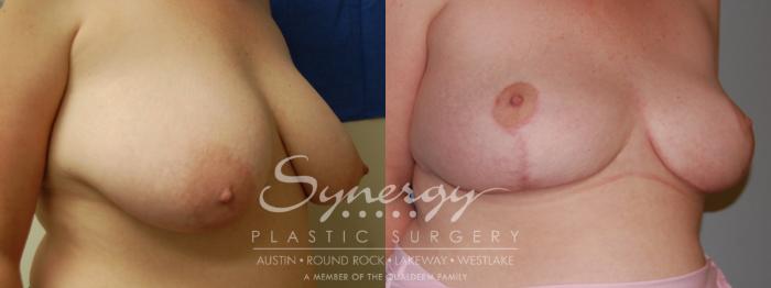 Before & After Breast Reduction Case 5 View #5 View in Austin, TX