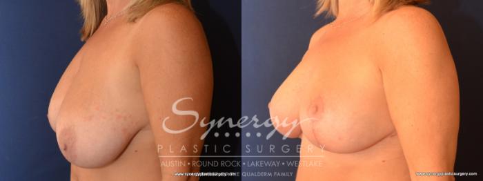 Before & After Breast Reduction Case 573 View #2 View in Austin, TX