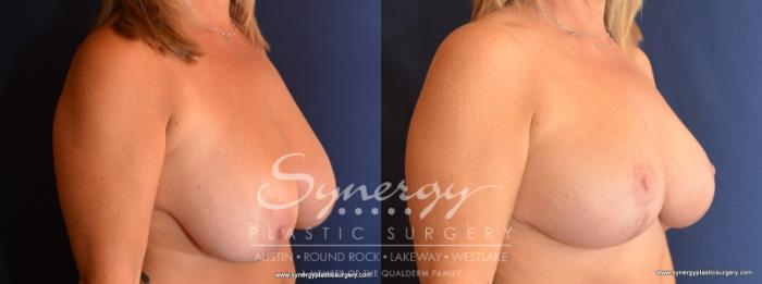 Before & After Breast Reduction Case 573 View #3 View in Austin, TX