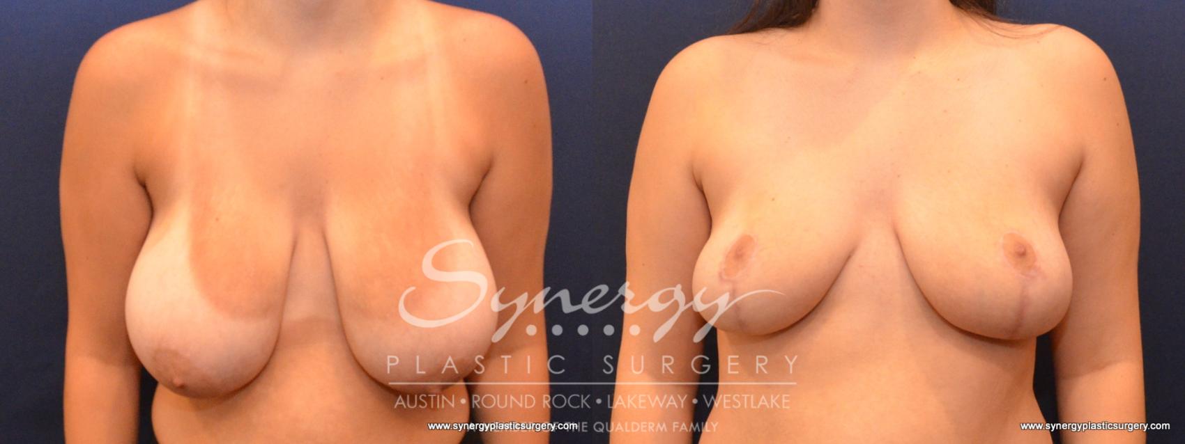 Before & After Breast Reduction Case 584 View #1 View in Austin, TX