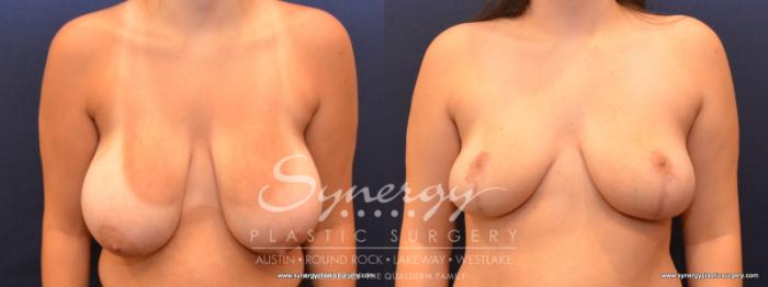 Before & After Breast Reduction Case 584 View #1 View in Austin, TX