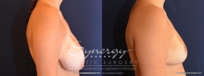 Before & After Breast Reduction Case 584 View #3 View in Austin, TX