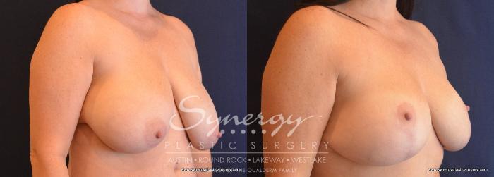 Before & After Breast Reduction Case 701 View #5 View in Austin, TX