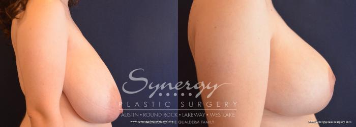 Before & After Breast Reduction Case 726 View #3 View in Austin, TX