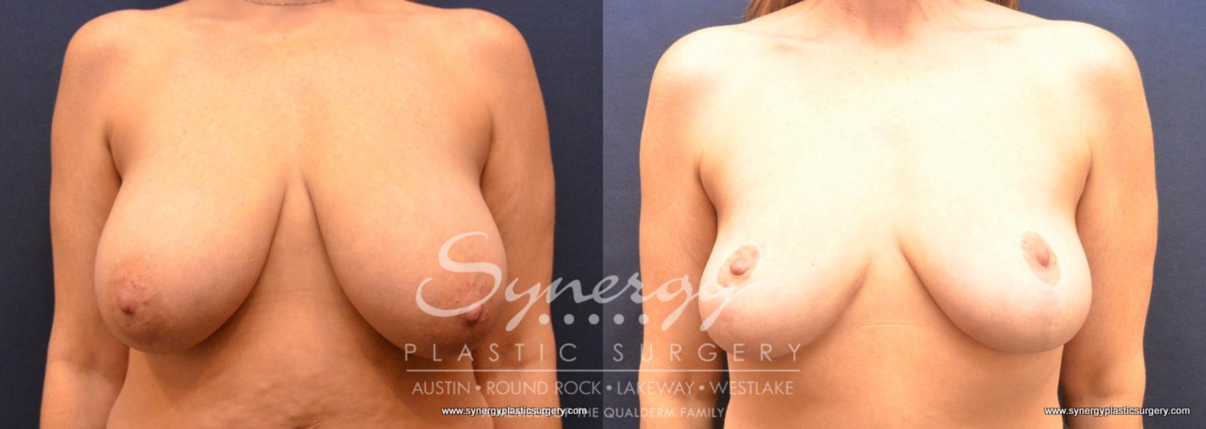 Before & After Breast Reduction Case 759 View #1 View in Austin, TX