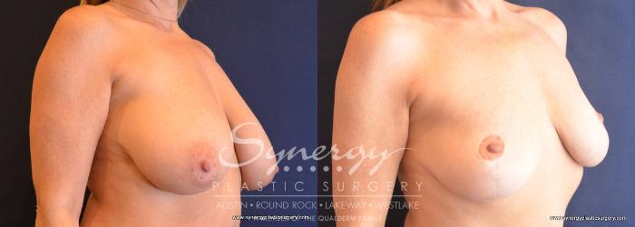 Before & After Breast Reduction Case 759 View #2 View in Austin, TX
