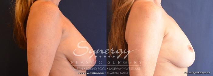 Before & After Breast Reduction Case 759 View #3 View in Austin, TX