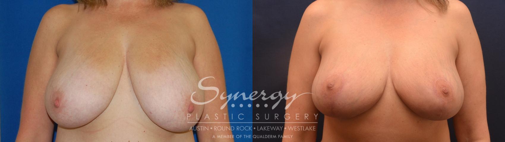 breast reduction