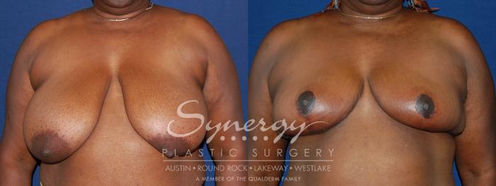 Before & After Breast Reduction Case 88 View #1 View in Austin, TX