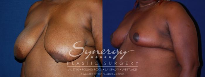 Before & After Breast Reduction Case 88 View #2 View in Austin, TX