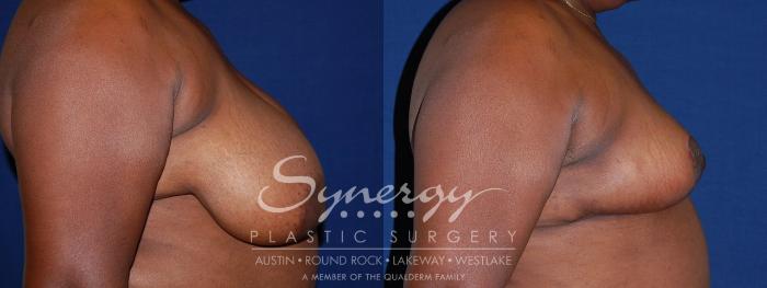 Before & After Breast Reduction Case 88 View #3 View in Austin, TX
