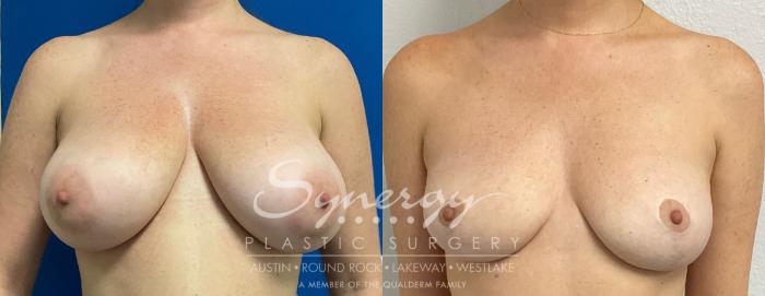 Before & After Breast Reduction Case 888 Front View in Austin, TX