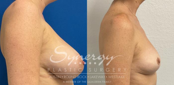 Before & After Breast Reduction Case 888 Left Side View in Austin, TX