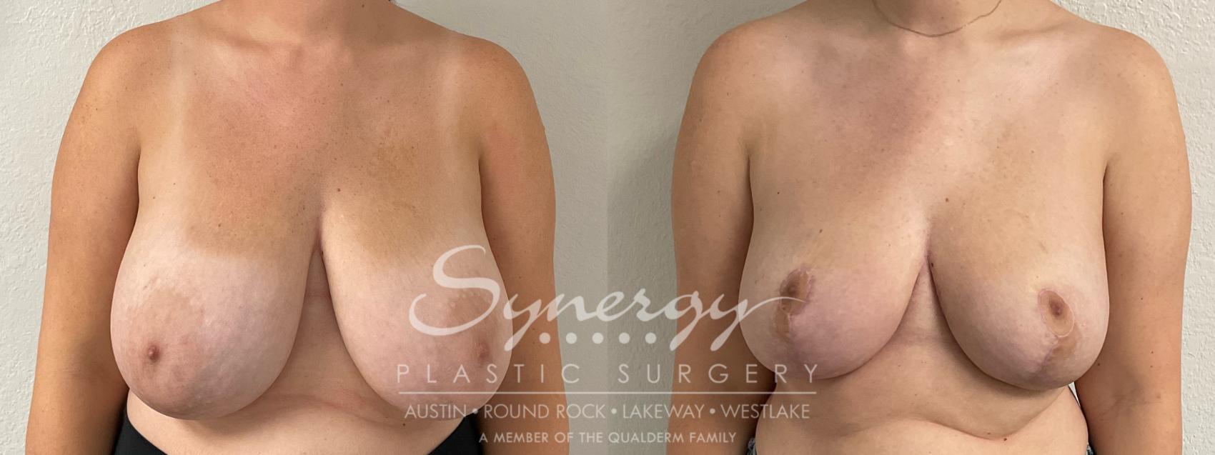 Before & After Breast Reduction Case 893 Front View in Austin, TX