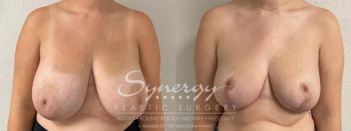 Before & After Breast Reduction Case 893 Front View in Austin, TX