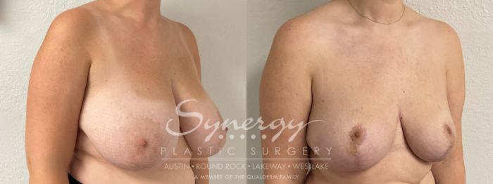 Before & After Breast Reduction Case 893 Right Oblique View in Austin, TX