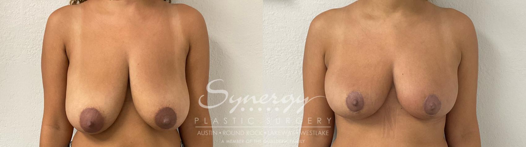 Before & After Breast Reduction Case 927 Front View in Austin, TX