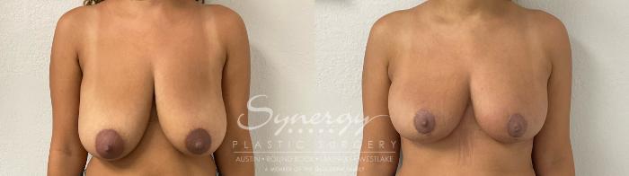 Before & After Breast Reduction Case 927 Front View in Austin, TX
