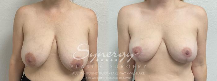 Before & After Breast Reduction Case 948 Front View in Austin, TX