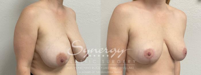 Before & After Breast Reduction Case 948 Right Oblique View in Austin, TX