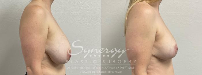 Before & After Breast Reduction Case 948 Right Side View in Austin, TX
