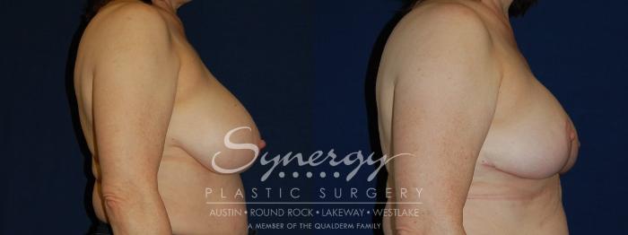 Before & After Breast Reduction Case 98 View #1 View in Austin, TX