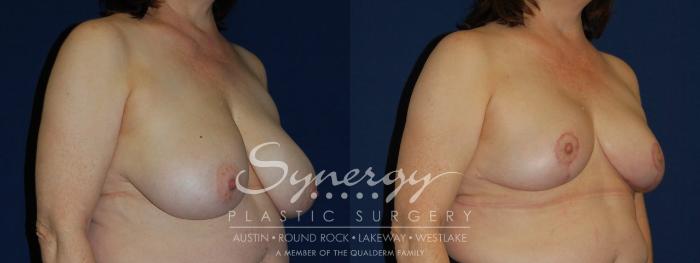 Before & After Breast Reduction Case 98 View #3 View in Austin, TX