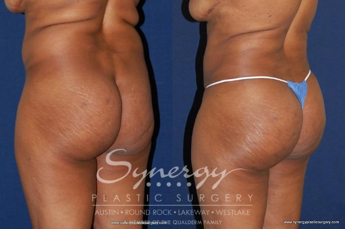 Before & After Buttock Augmentation/Brazilian Butt Lift Case 180 View #1 View in Austin, TX