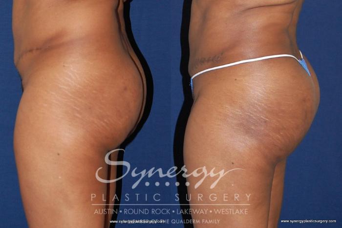 Before & After  Case 180 View #2 View in Austin, TX