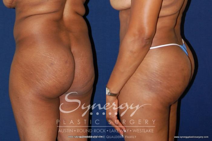 Before & After  Case 180 View #3 View in Austin, TX