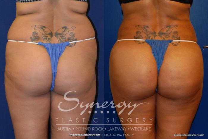 Before & After  Case 210 View #3 View in Austin, TX