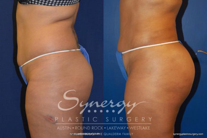 Before & After  Case 210 View #5 View in Austin, TX