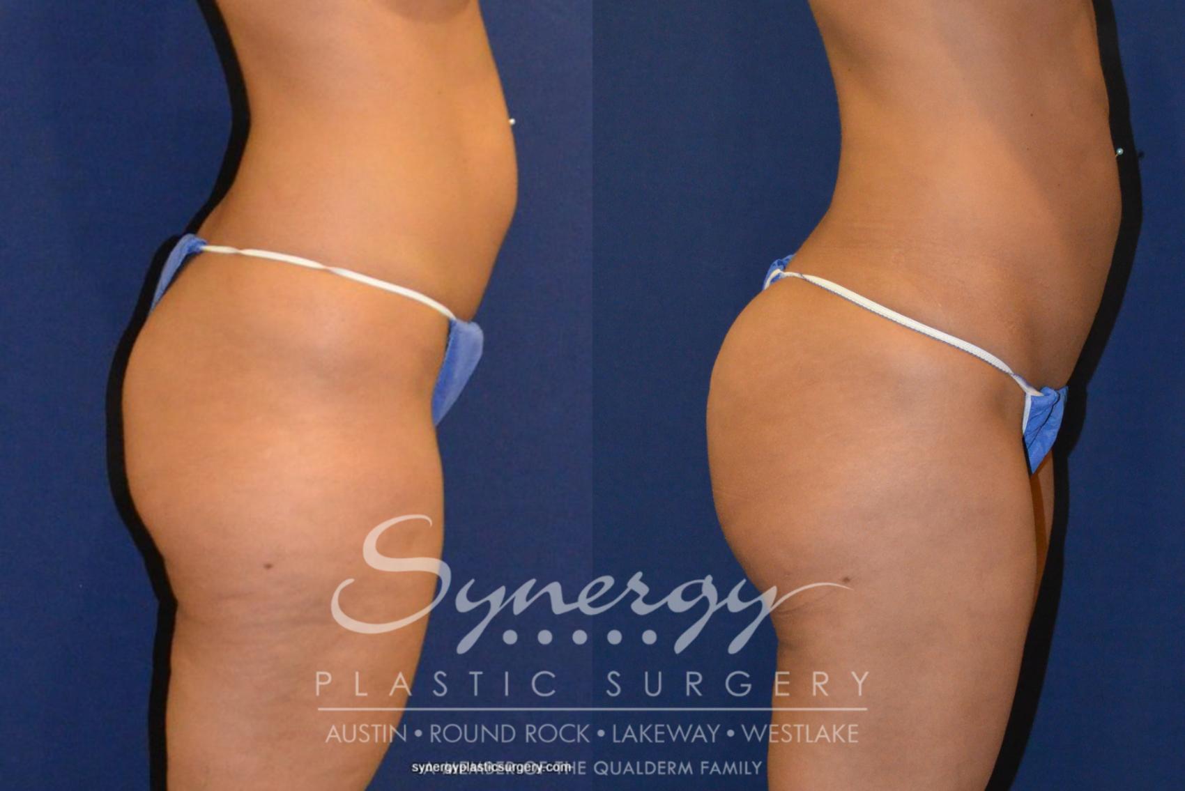 Before & After Buttock Augmentation/Brazilian Butt Lift Case 219 View #1 View in Austin, TX