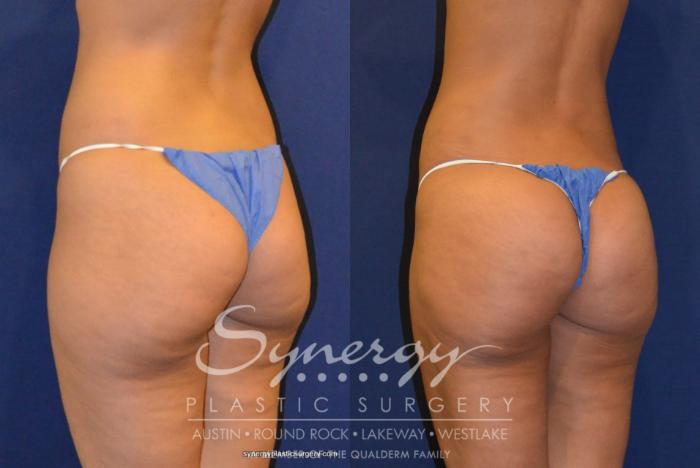 Before & After Buttock Augmentation/Brazilian Butt Lift Case 219 View #3 View in Austin, TX