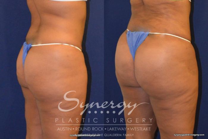 Before & After Buttock Augmentation/Brazilian Butt Lift Case 226 View #1 View in Austin, TX
